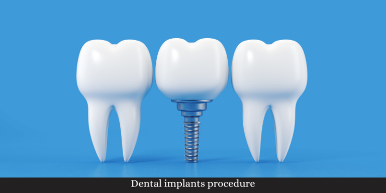 Root Canal Treatment