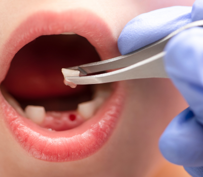 Signs of Wisdom Tooth Problems